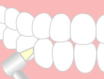 歯石の除去